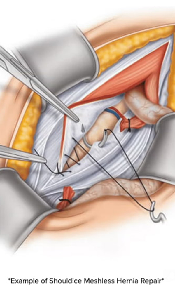 Illustration of tissue layers being sutured together in a Shouldice meshless hernia repair