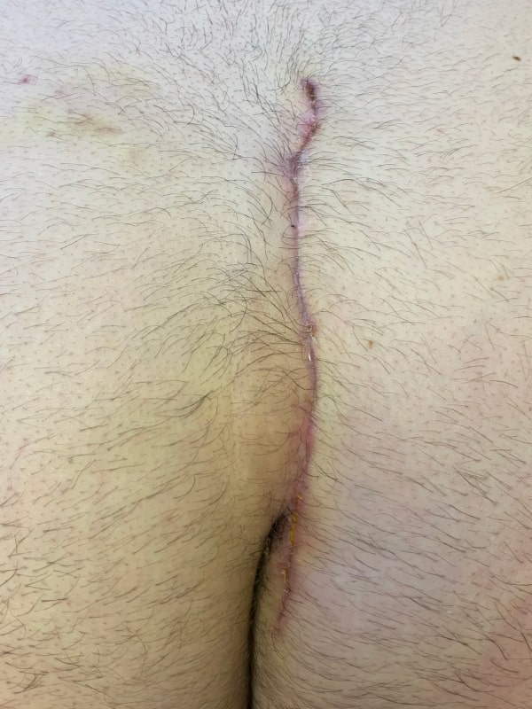 Pilonidal Cyst Treatment Before & After Image